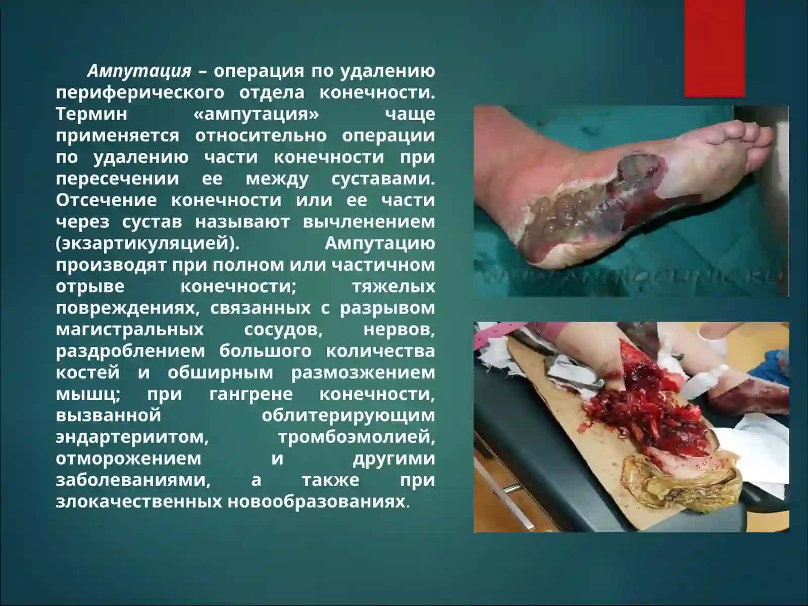 Ампутация протезирование и реабилитация инвалидов 2