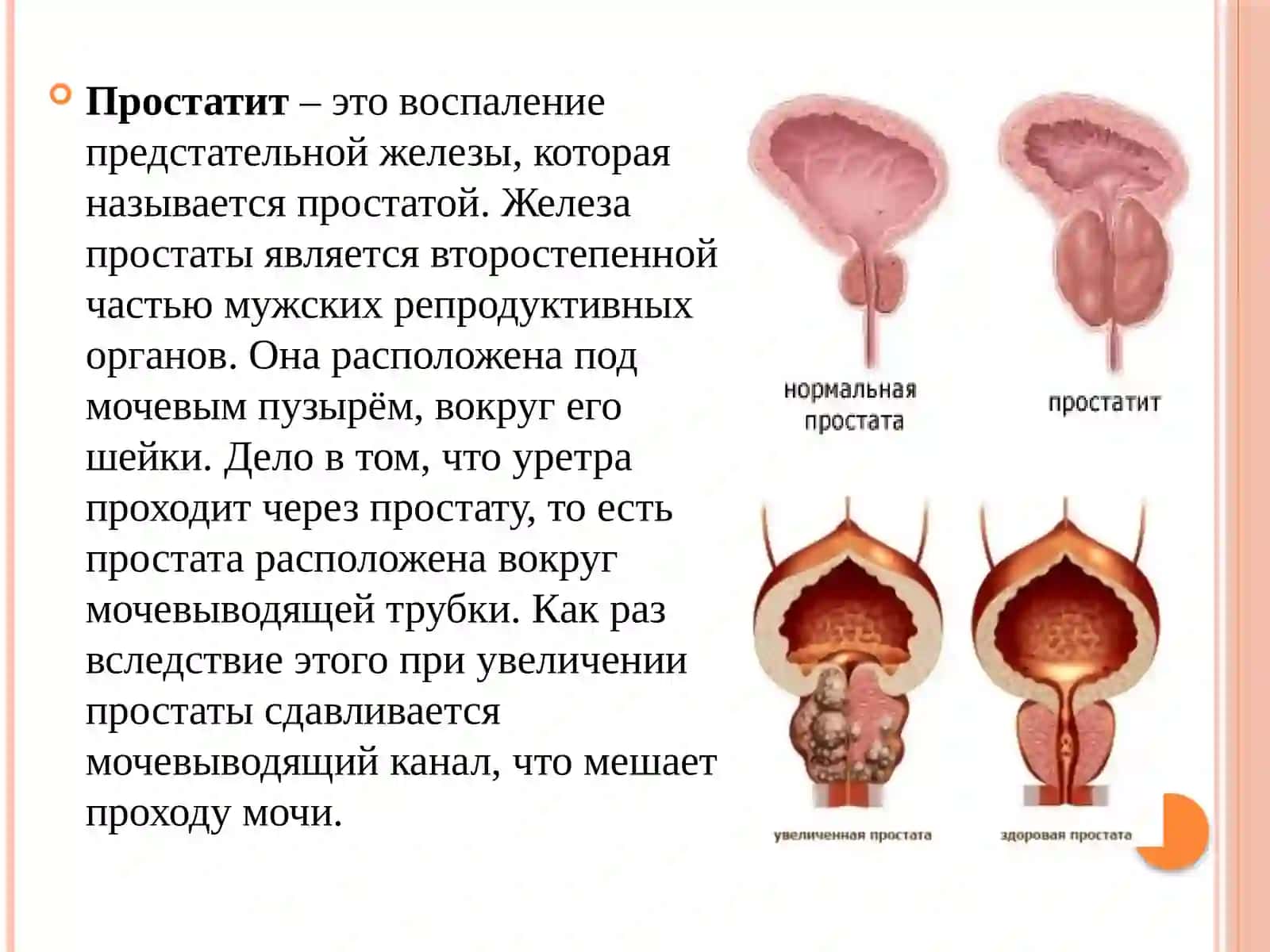 Простатит 2