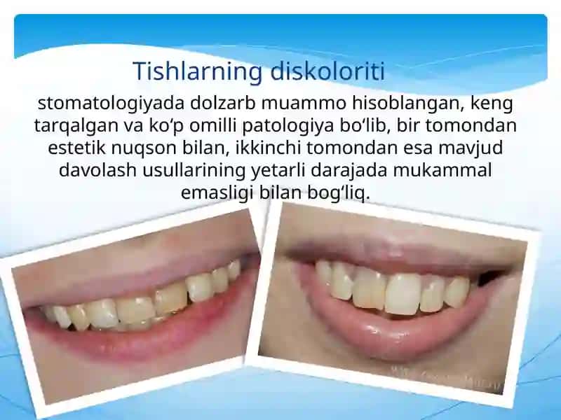 Nokarioz kasalliklarda tishlarni oqartirish prinsiplari 2
