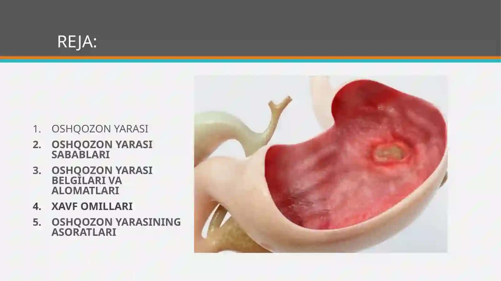 Oshqozonning yara kasalligi etiopatogenezi 2