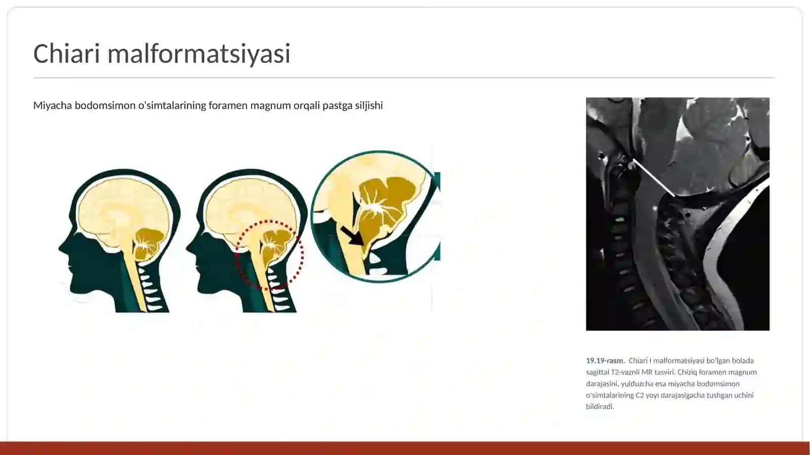 Chiari Malformatsiyalari// kiari anomaliyalri// kiari malformatsiyasi 2