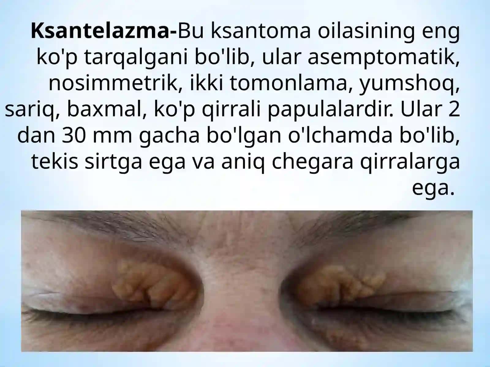 Ksantelazma.Lipoma.Gigroma 2