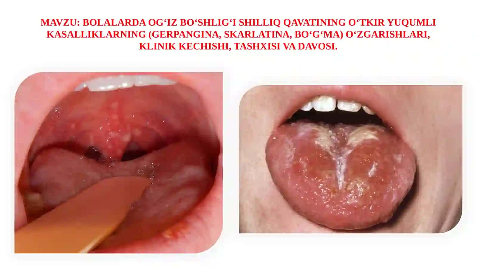 BOLALARDA OG‘IZ BO‘SHLIG‘I SHILLIQ QAVATINING O‘TKIR YUQUMLI KASALLIKLARNING (GERPANGINA, SKARLATINA, BO‘G‘MA) O‘ZGARISHLARI, KLINIK KECHISHI, TASHXISI VA DAVOSI 2
