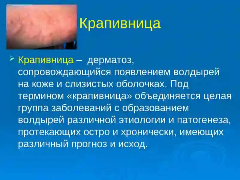 Крапивница 2