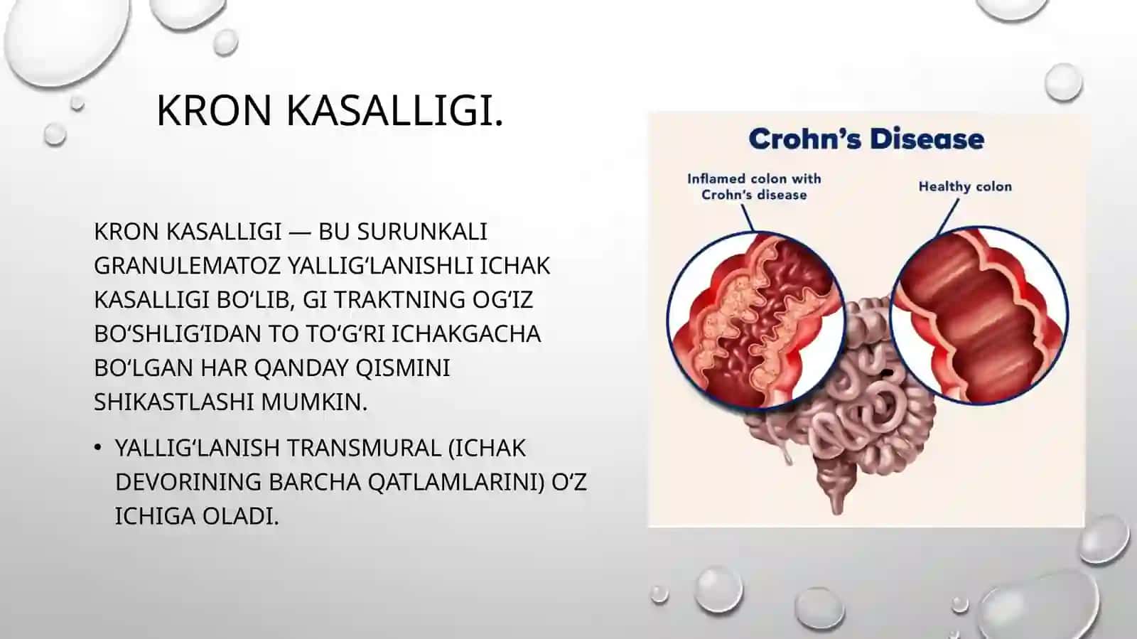 Kron kasalligi. Surunkali enterokolit 2