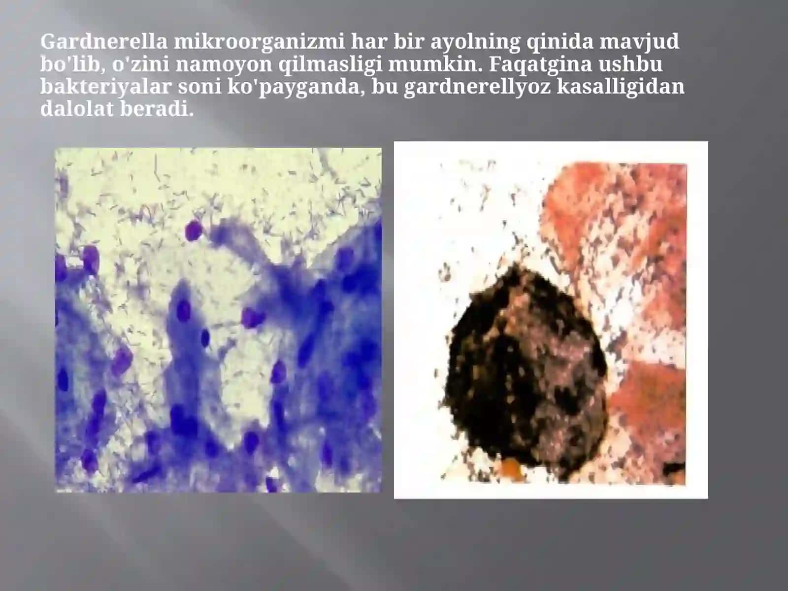 Bakterial vaginoz sabablari va davolash 2