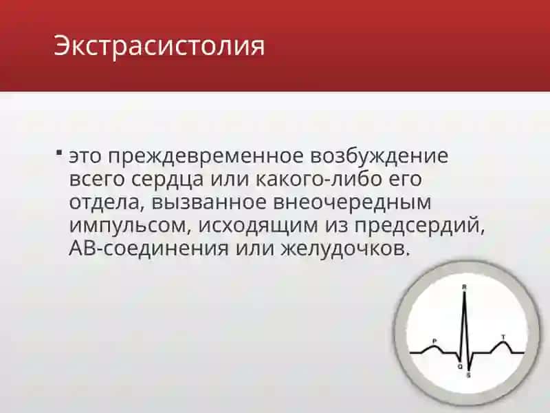 Экстрасистолии 2