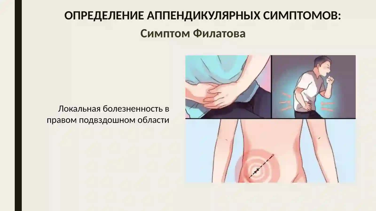 Ректальное исследование при тазовом аппендиците 2