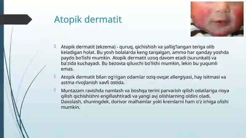 Atopik dermatitlar 2