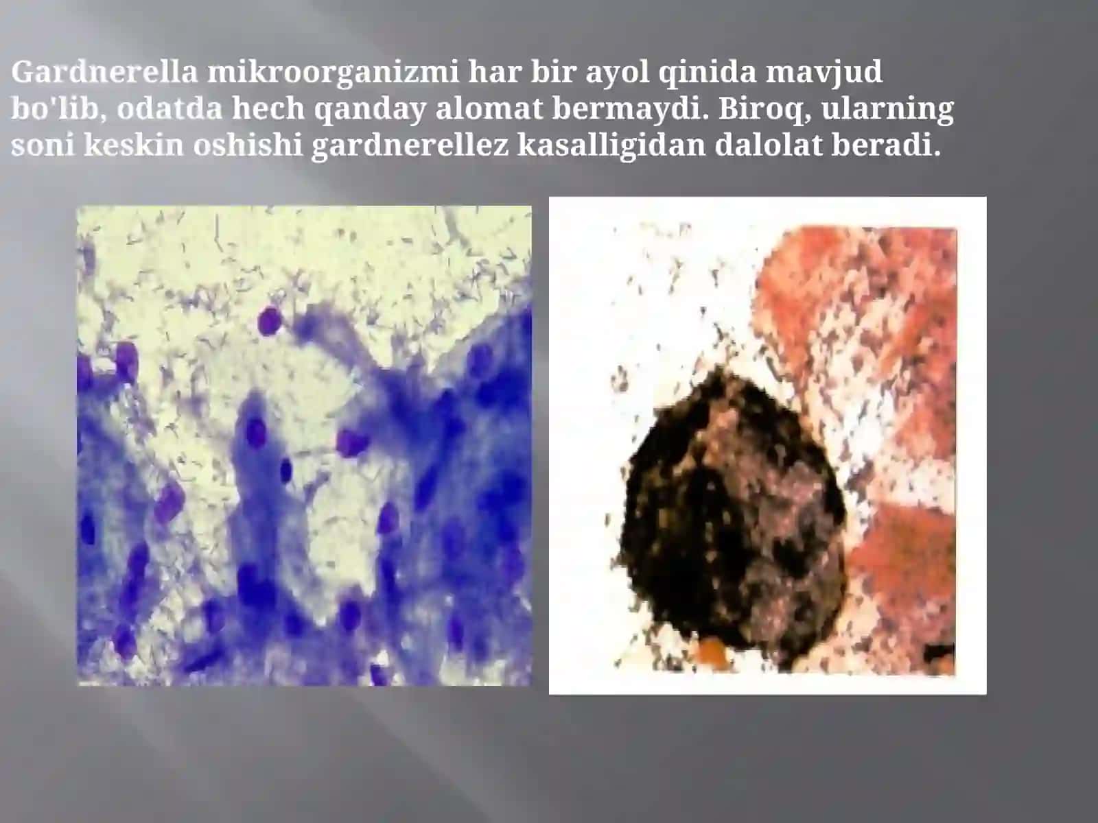 Bakterial vaginoz sabablari va davolash 2