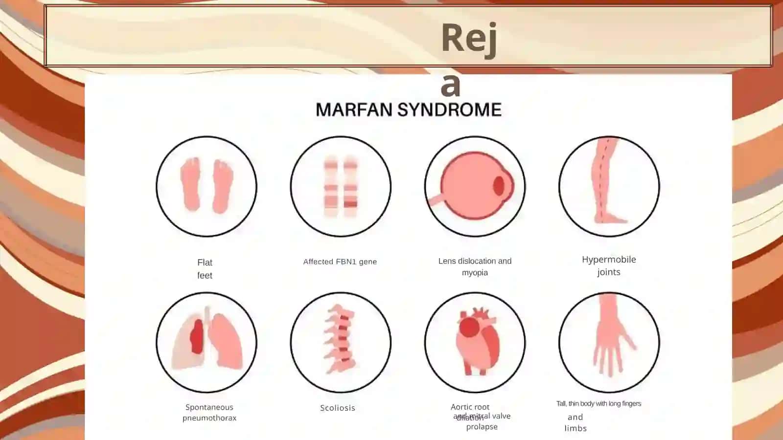 Marfan Sindromi 2