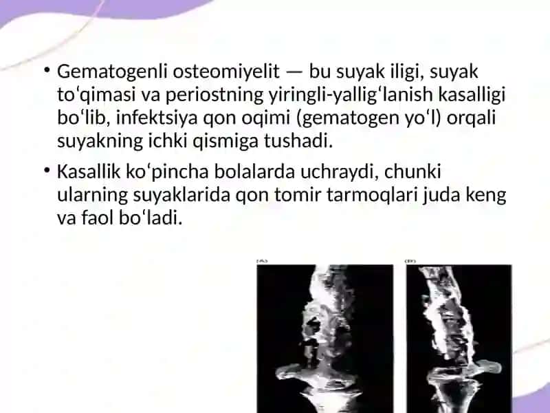 Gematogenli osteomiyelit 2