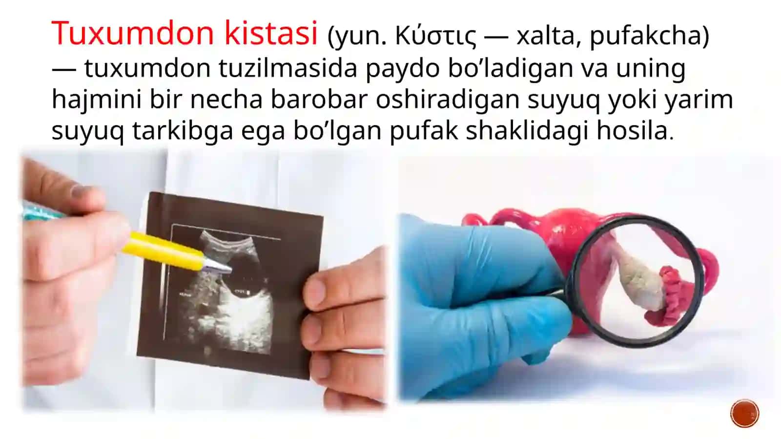 Tuxumdon kistasi 2