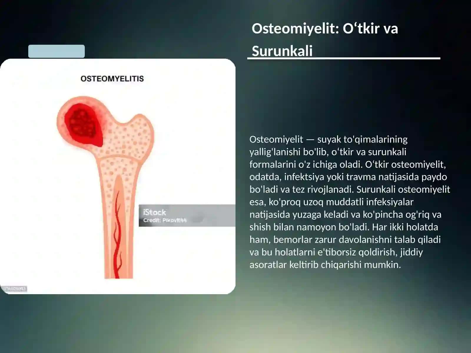 Osteomiyelitlar: o‘tkir va surunkali, yiringli artrit, klinik ko‘rinishi, diagnostika va davosi: Kaft flegmonasi, panaritsiy(xasmol): klinikasi,maxalliy va umumiy belgilari, diagnostikasi, davolash prinsiplari 2