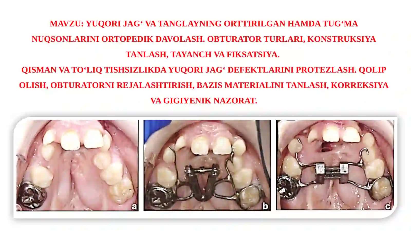 Yuqori Jag' va Tanglayning Ortirilgan Hamda Tug'ma Nuqsonlarini Ortopedik Davolash 2