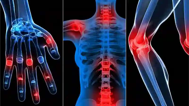 Osteoartritnima 2