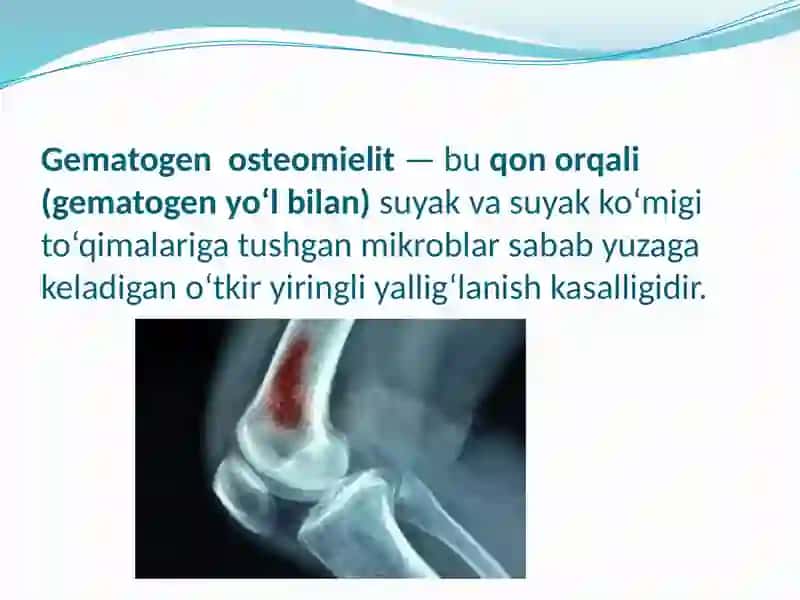 Gematogen osteomielit 2
