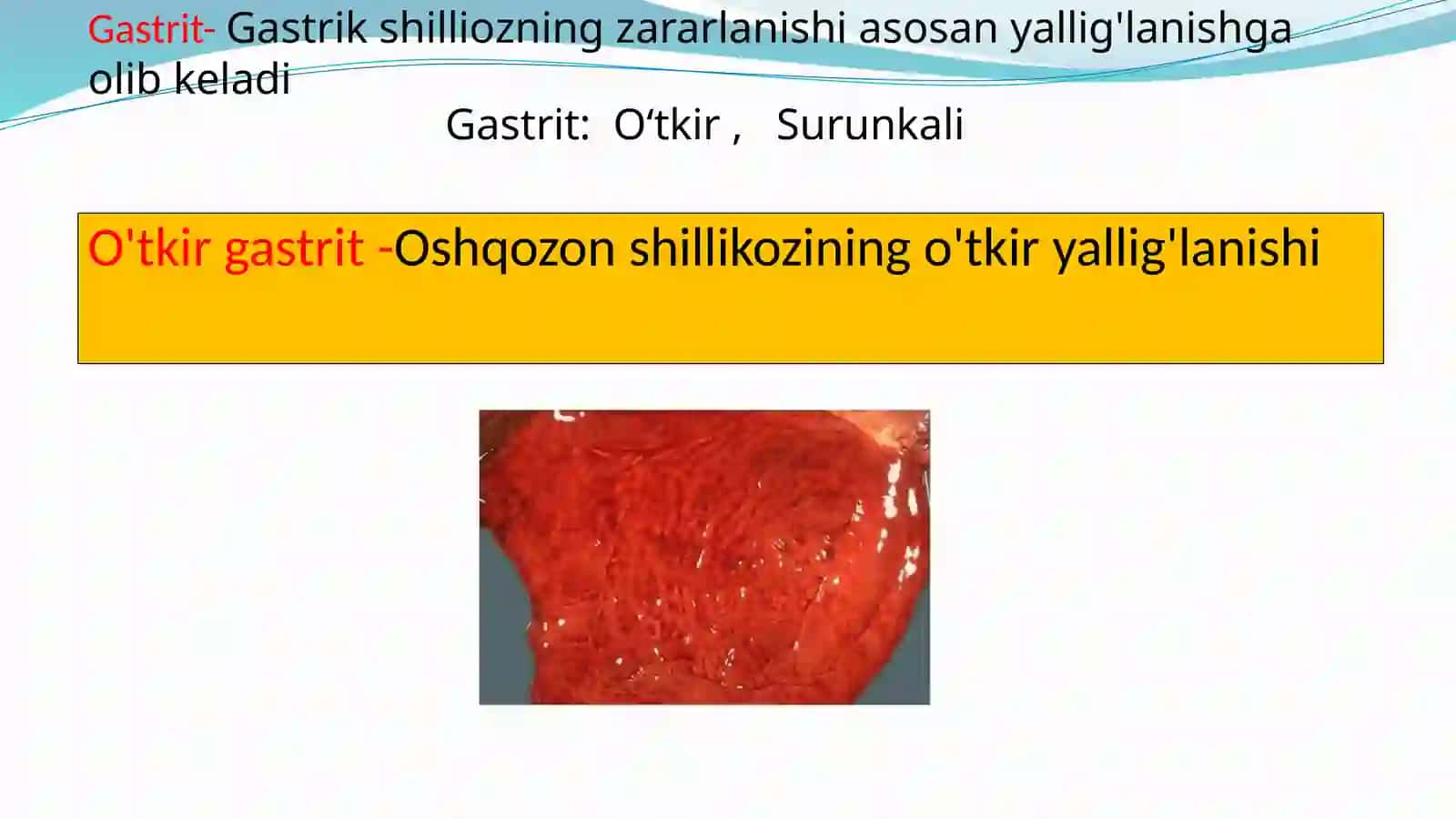 Gastrit 2