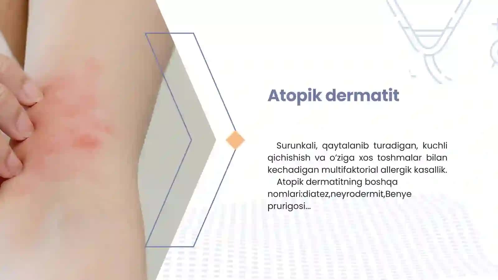 Atopik dermatit 2