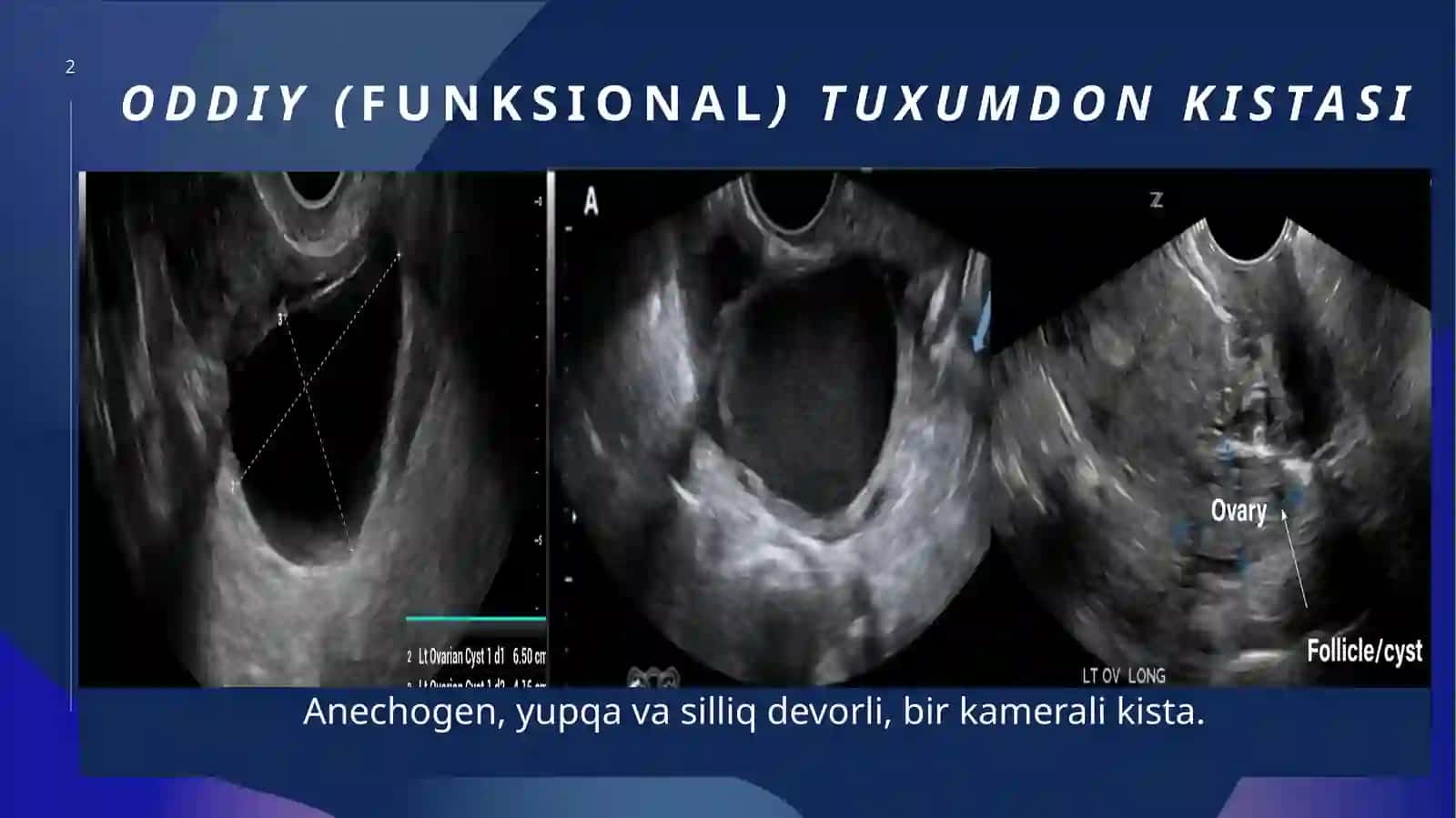 Tuxumdonlar kistasida UTT diagnostikasi 2