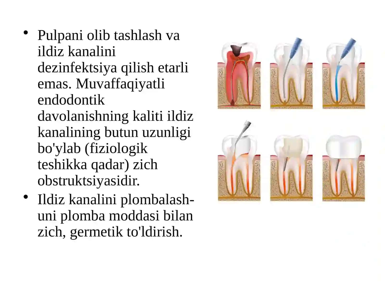 Ildiz kanalini plombalash 2
