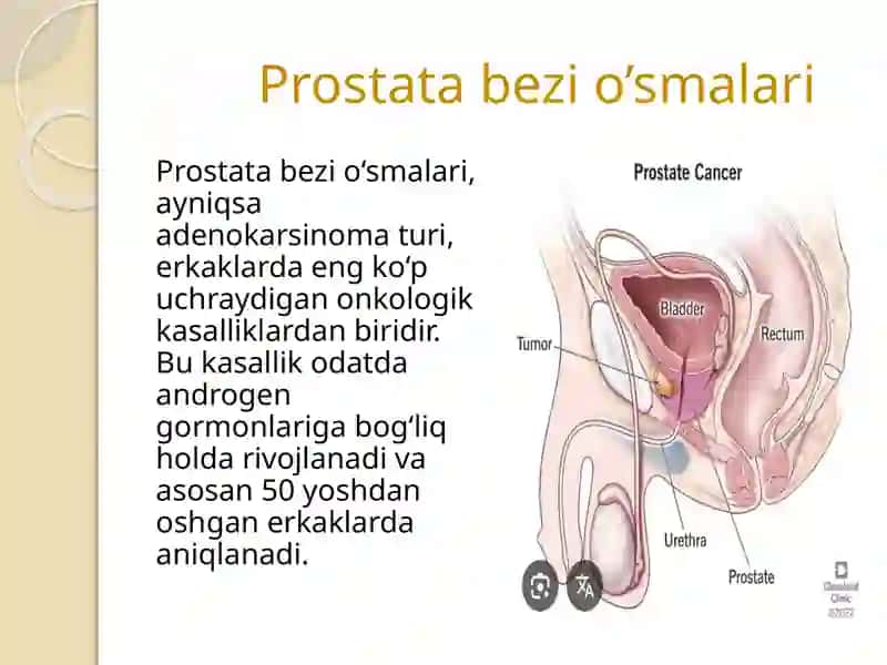 Prostatabezio’smalari 2