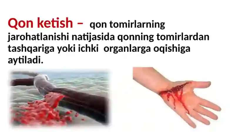 Arterial qonketish 2