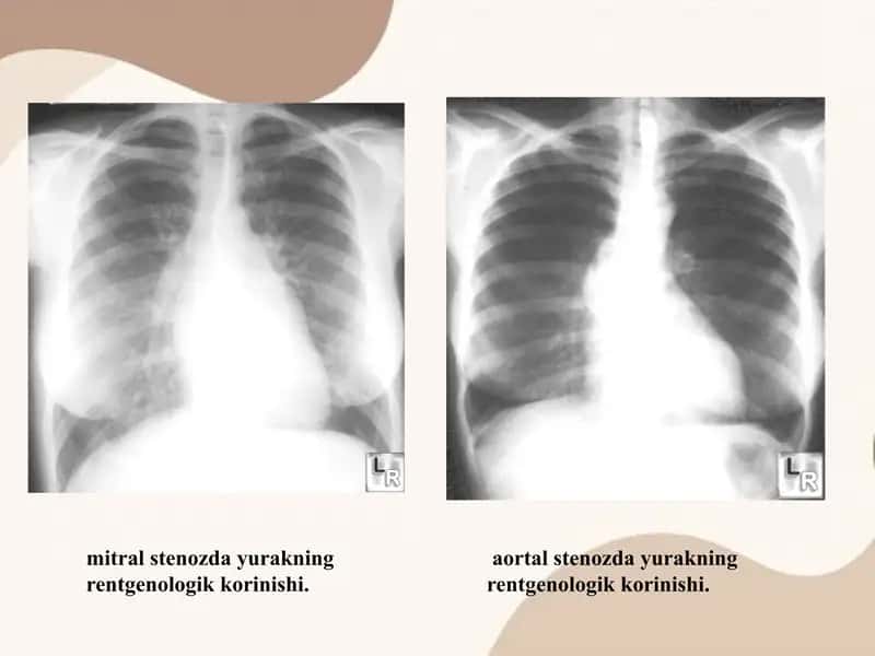 YURAK VA QON-TOMIRLAR KASALLIKLARI NUR TASHXISI 2
