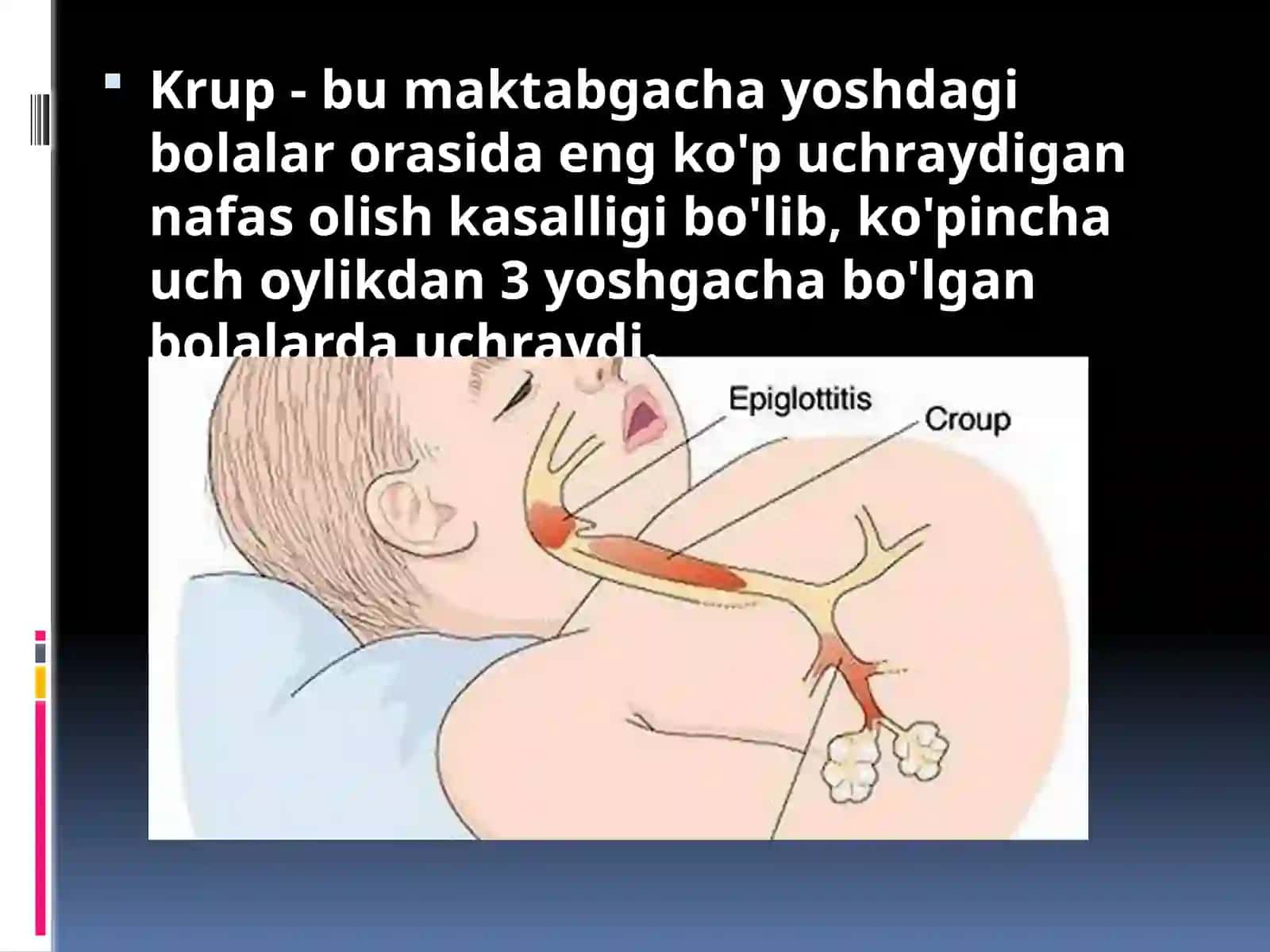 Krup sindromi 2