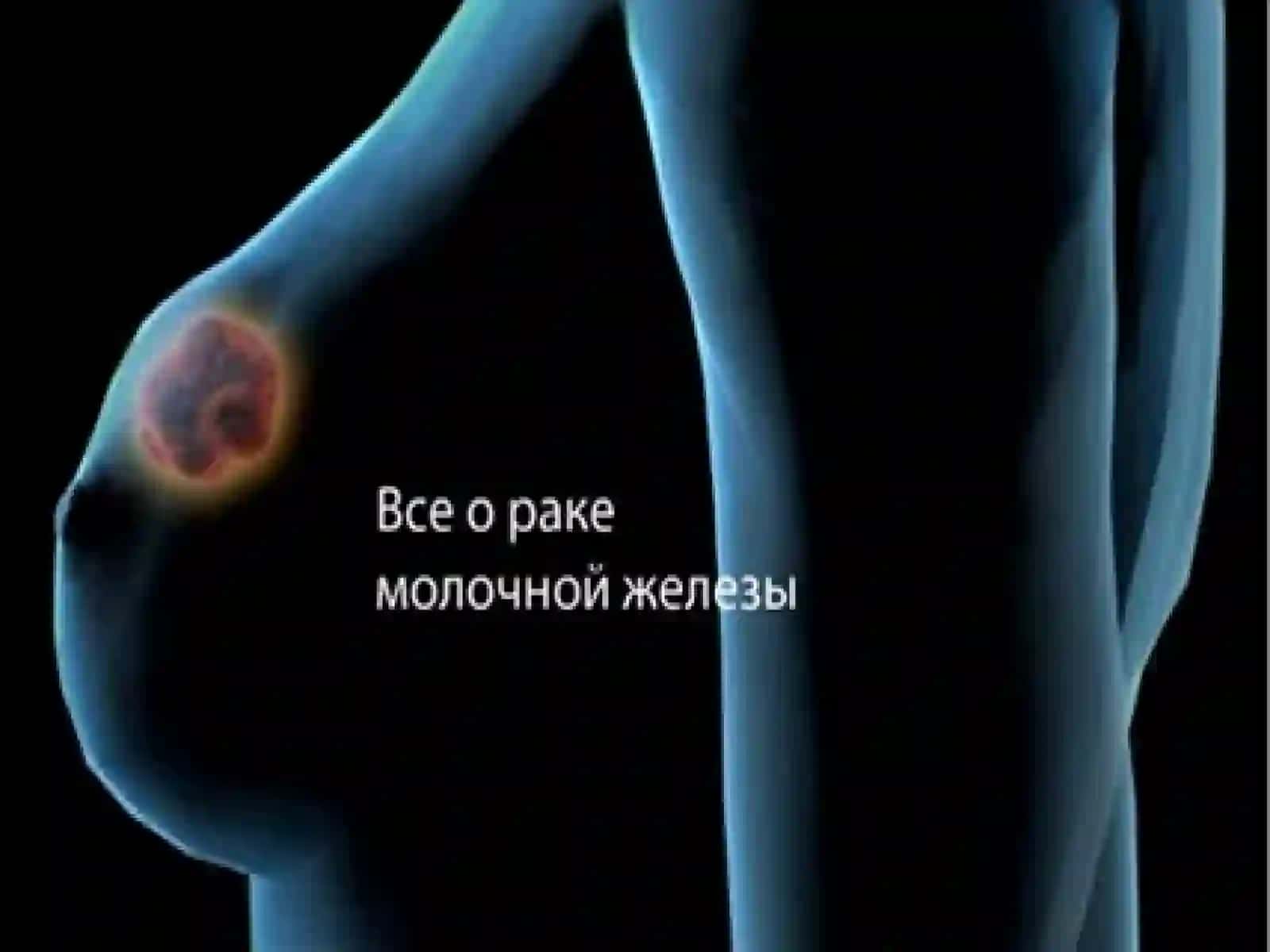 Sut bezi saratoni diagnostikasi 2