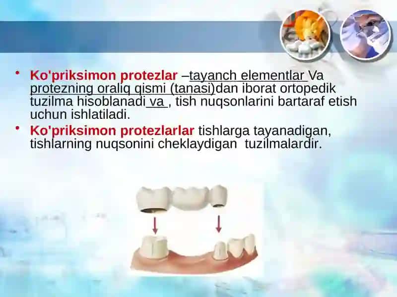 Qisman tish qatori nuqsonida ko‘priksimon protezlar bilan protezlash asoslari 2
