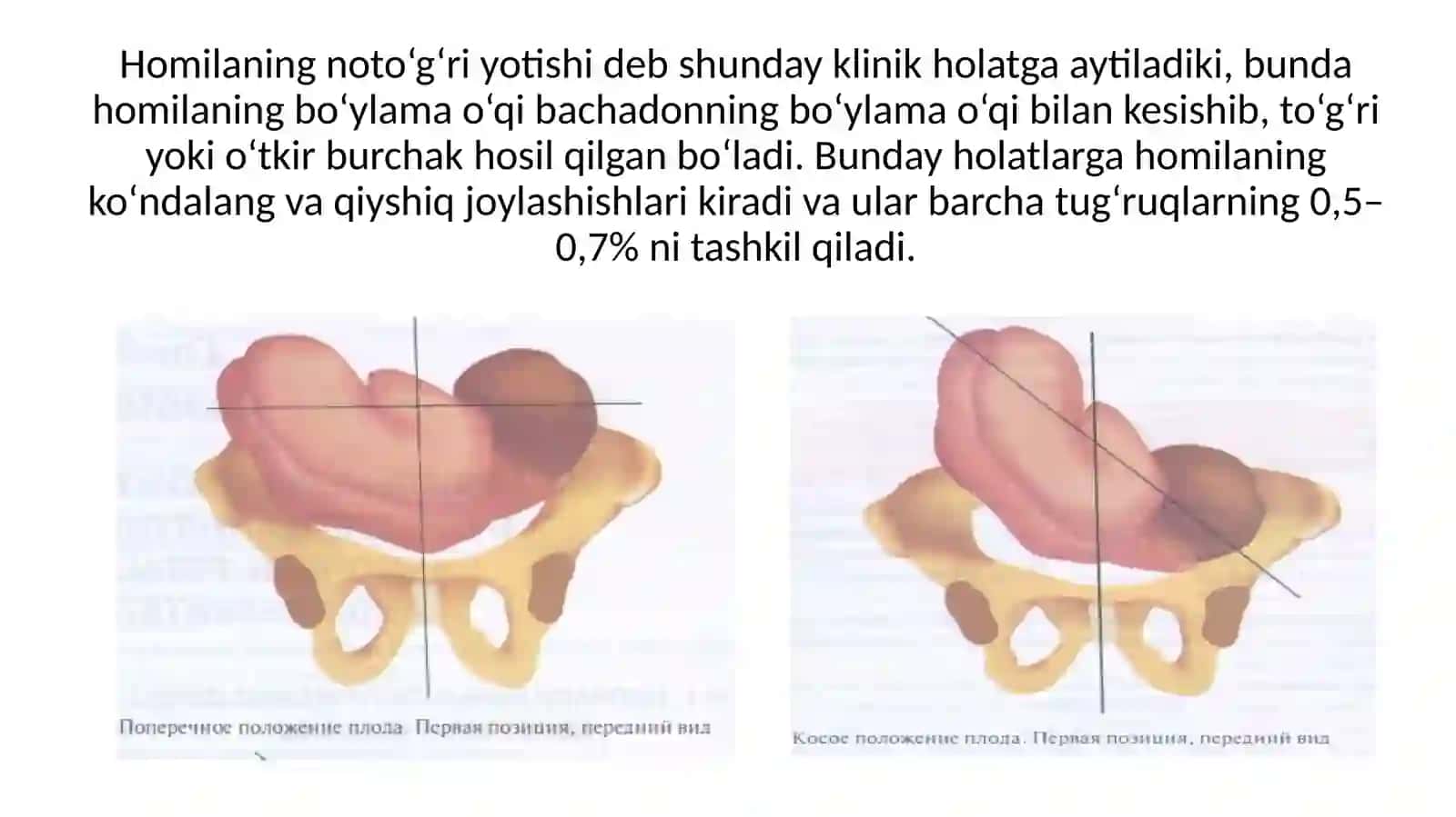 Homilaning noto'g'ri joylashishi 2