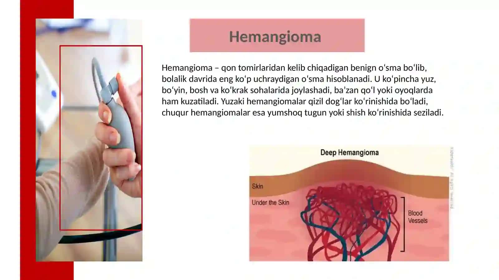 Teri va Yumshoq To'qimalarning Xavfsiz O'smalari: Hemangioma, Limfangioma, Teratoma 2