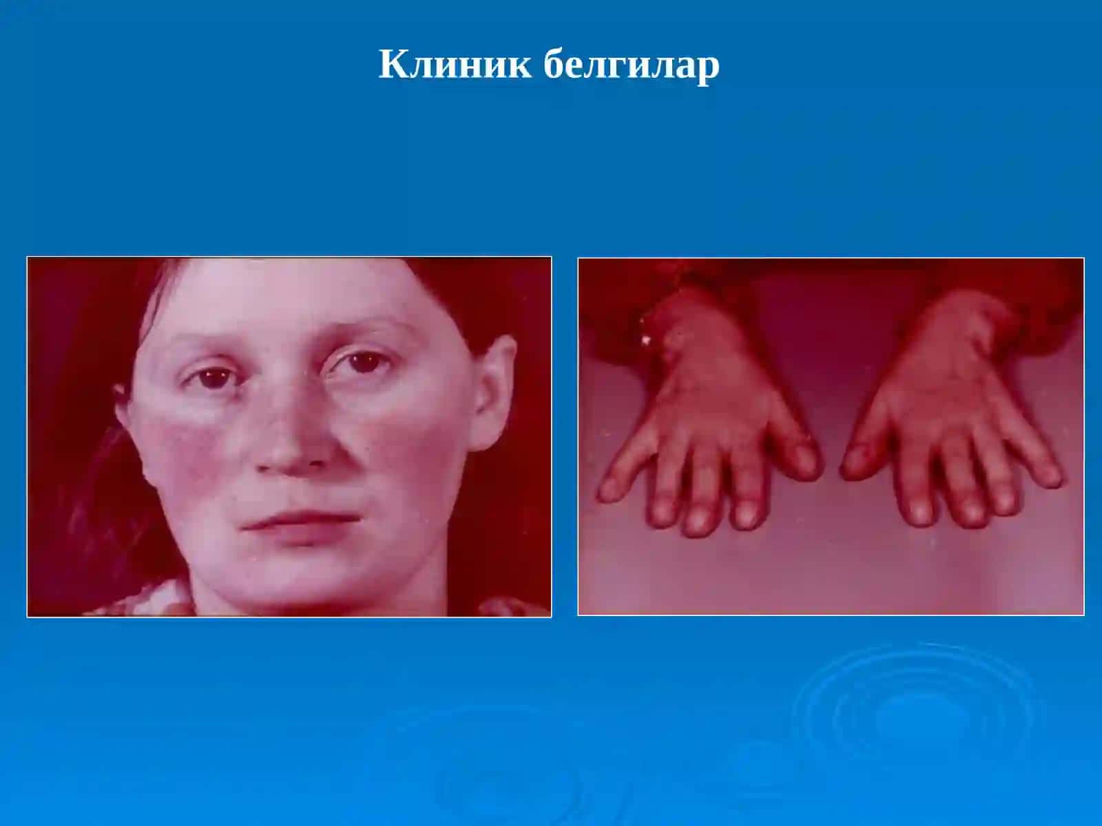 Орттирилганюрак нуқсонлари 2