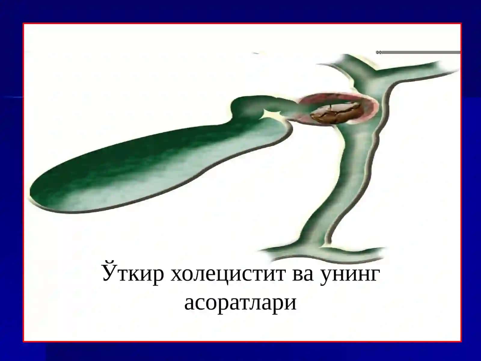 Ўткир холецистит,ўт тош касаллиги клиникаси, ташхисқўйиш, солиштирма ташхис ва даволаш. Сурункали холецистит 2