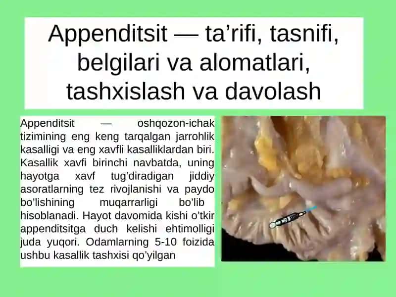O‘tkirappenditsit 2