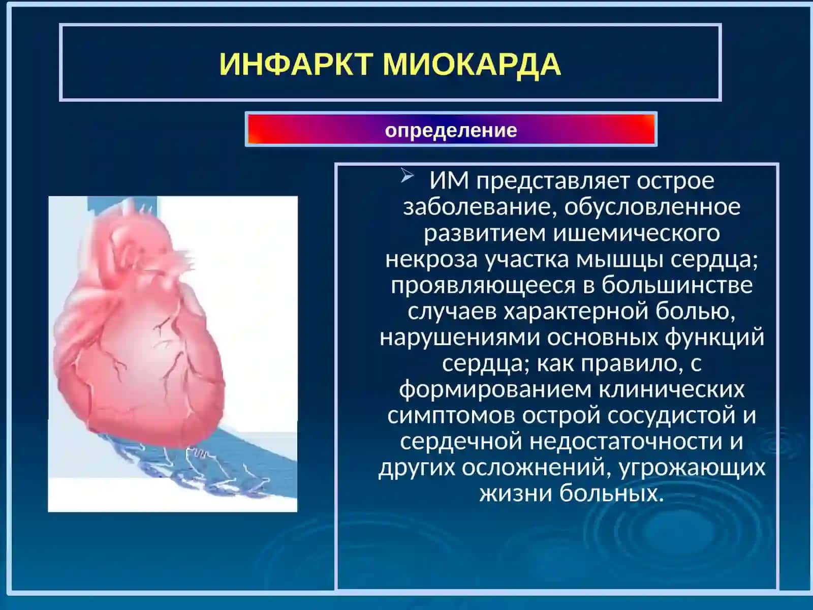 ИНФАРКТ МИОКАРДА 2