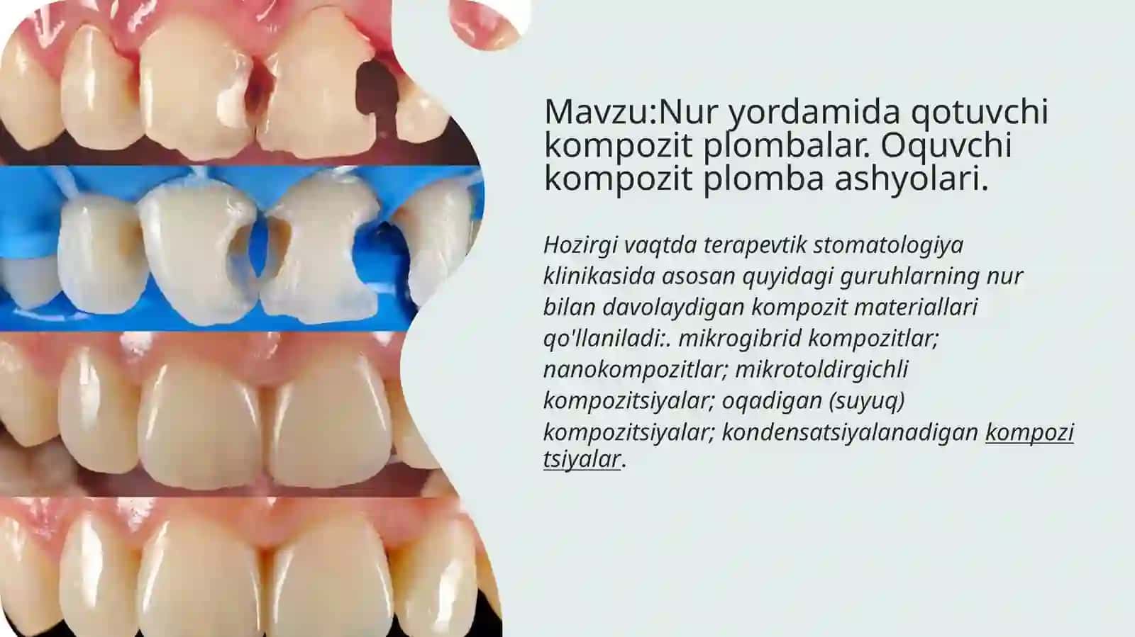 Nuryorda mida qotuvchi kompozit plombalar 2