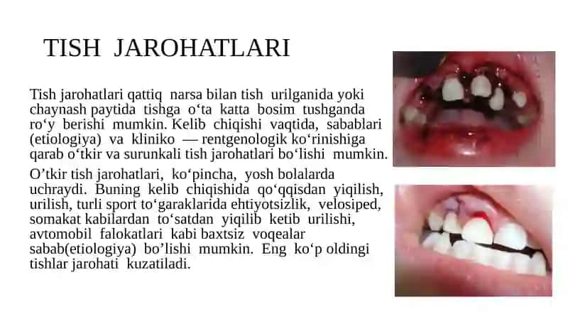 Tish chiqqandan keyin paydo bo’luvchi nokarioz kasalliklar. Tish jarohatlari. Etiologiya. Klinika. Diagnostika. Davolash 2