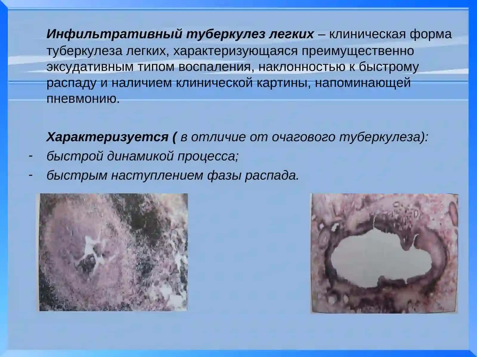 Инфильтративный туберкулез легких 2