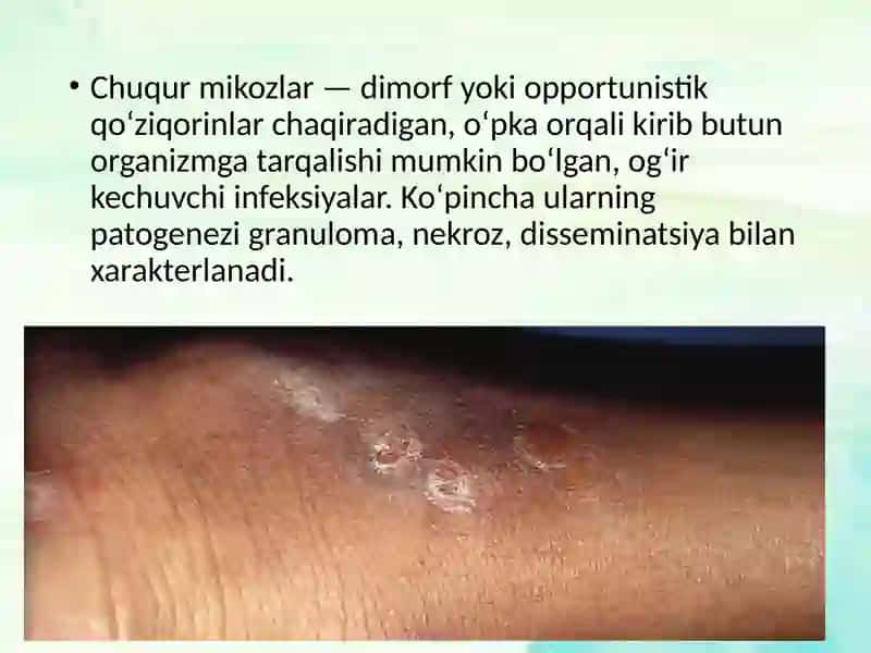 Chuqur mikozlar 2