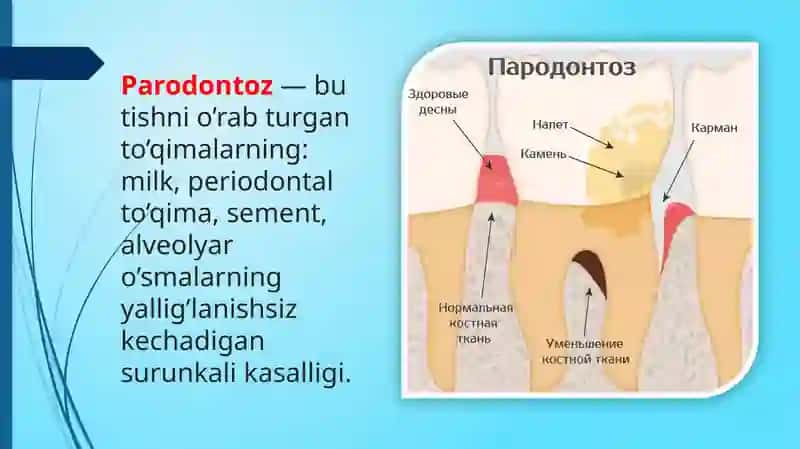Bolalarda Parodontoz 2