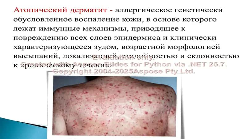 Атопический дерматит 2