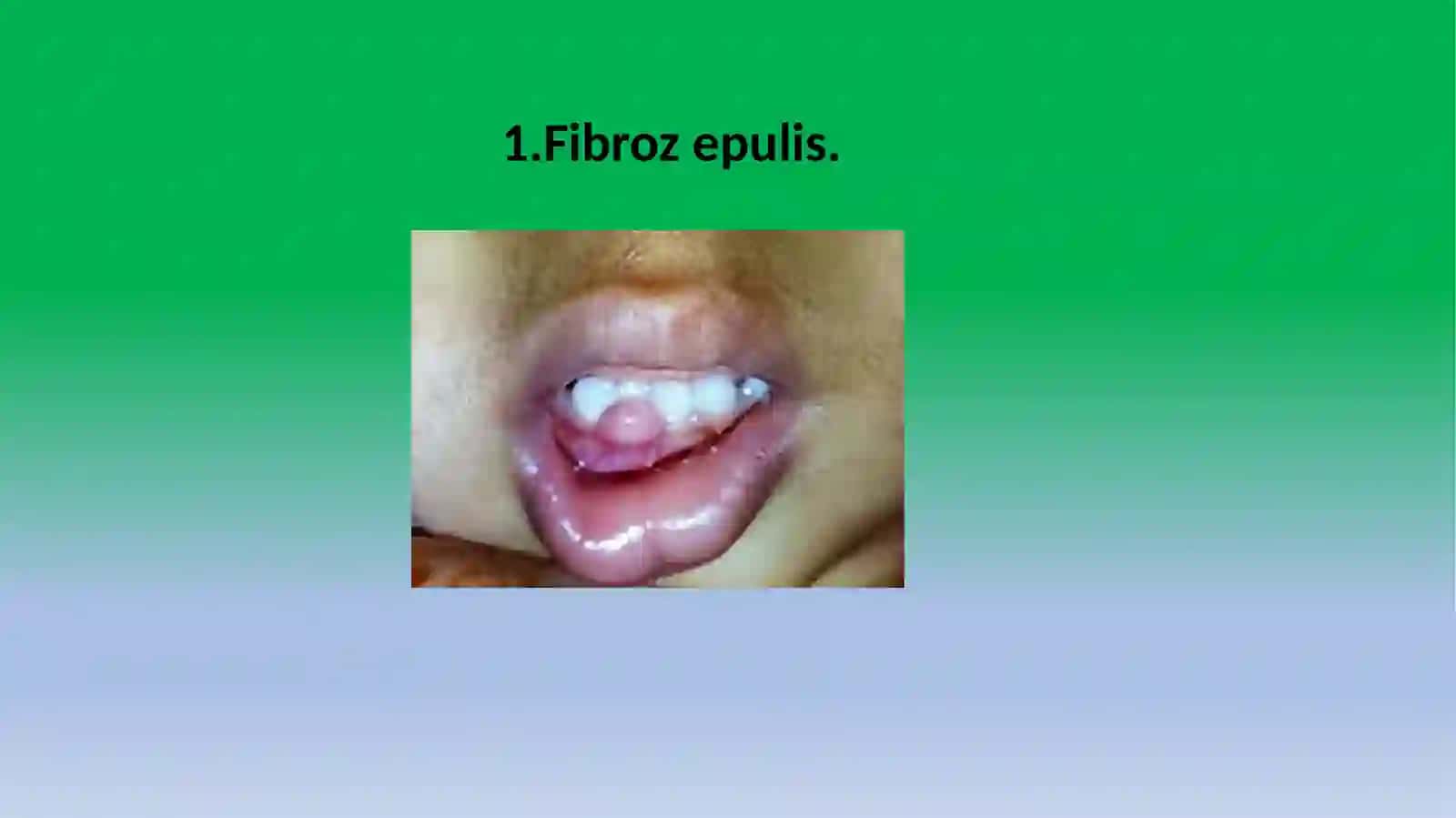 Юз-жағ сохаси ўсмасимон касалликлари 2