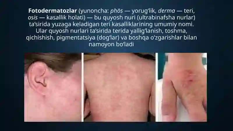Fotodermatozlar 2