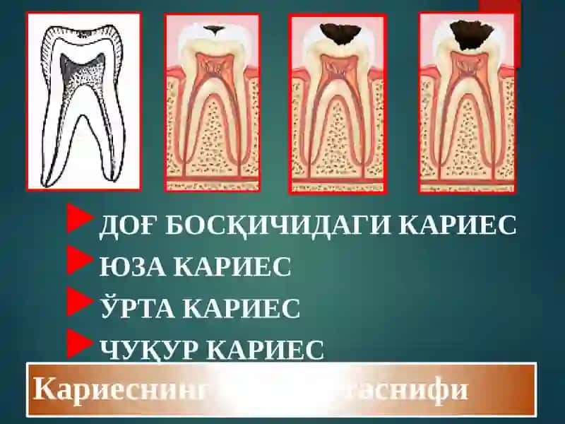 Кариеснинг клиник таснифи 2
