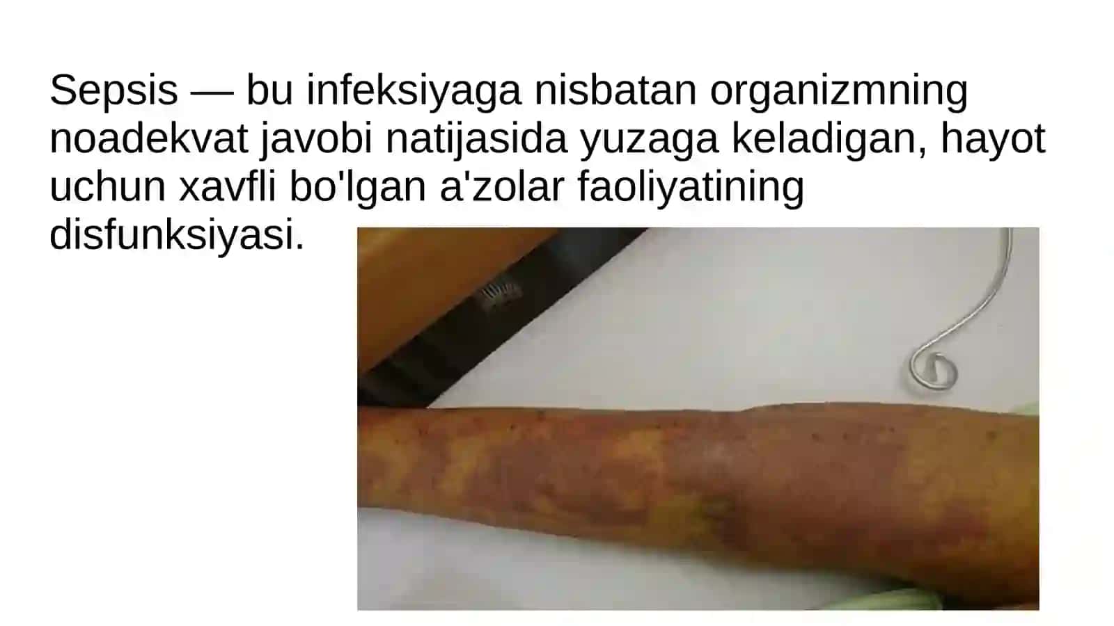 Sepsis 2