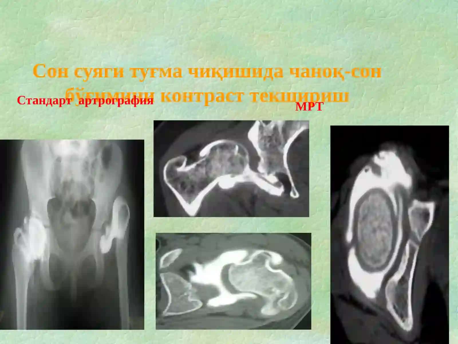 Симптом Барлоу 2