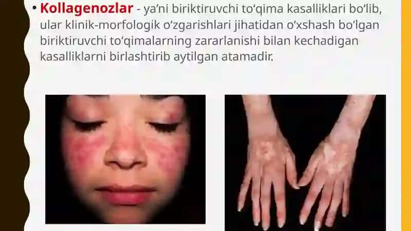 Kollagenozlar 2