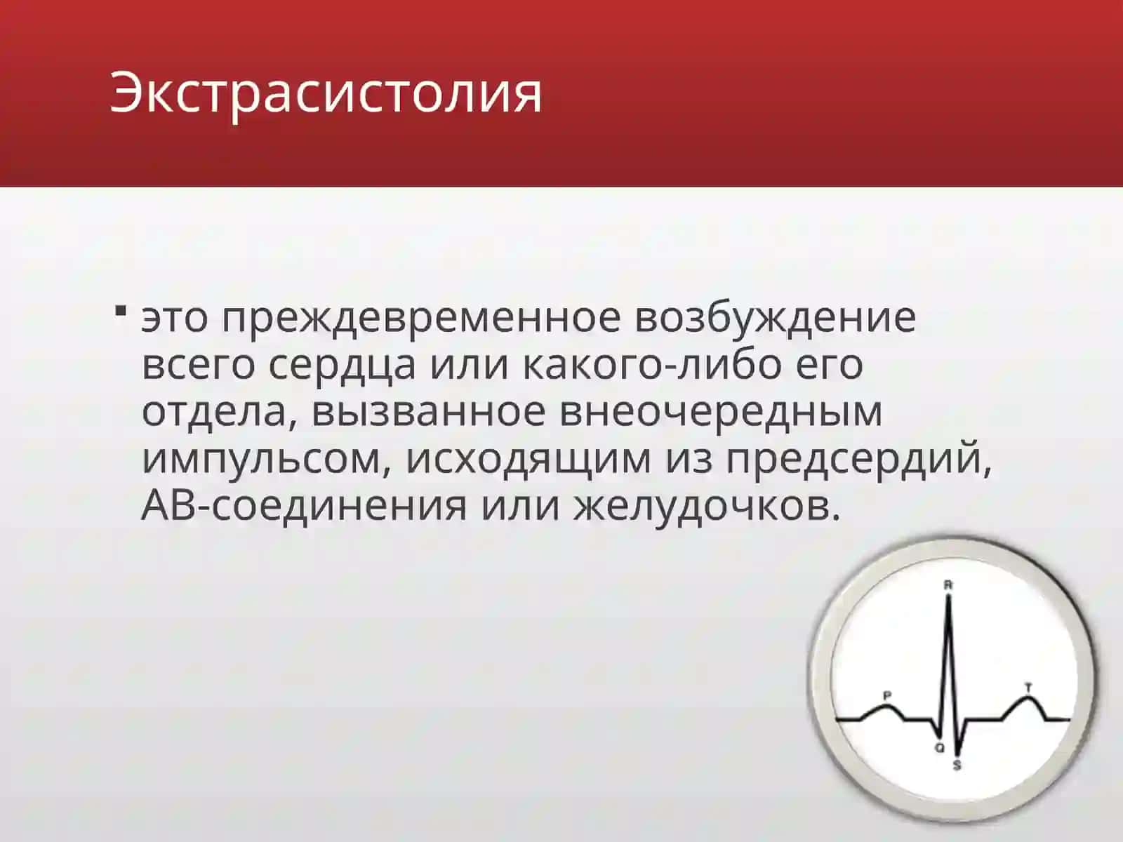 Экстрасистолии 2